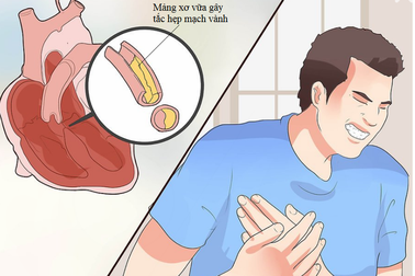 Triệu chứng bệnh mạch vành không phải lúc nào cũng bắt đầu bằng cơn đau thắt ngực
