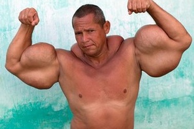 Tiêm dầu khoáng và cồn vào cơ thể để sở hữu bắp tay “khủng”