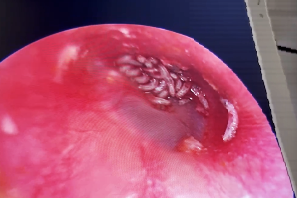 Gần 20 con giòi bò lúc nhúc trong tai người phụ nữ ở TPHCM - 1