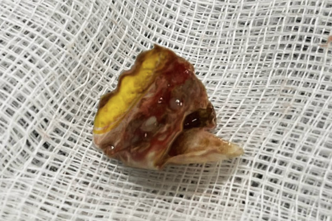 Nuốt vỏ bịch dầu gội đầu trong lúc tắm, người đàn ông tử vong thương tâm - 1 Nuốt vỏ bịch dầu gội đầu trong lúc tắm, người đàn ông tử vong thương tâm - 1