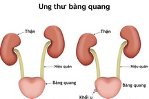 Phát hiện sớm ung thư bàng quang