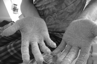 Phát hiện mắc ung thư từ nốt phát ban nhỏ ở thắt lưng