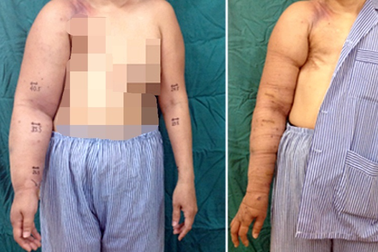 Cánh tay phù to gây đau đớn, bệnh nhân chỉ mong bác sĩ cắt bỏ