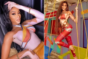 Siêu mẫu bạch biến khoe dáng hoàn hảo trong ảnh quảng cáo mới