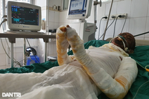 Người đàn ông bị bỏng gas khóc "xin cứu em với, em còn chưa báo hiếu mẹ…"