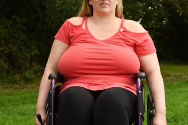 Phải ngồi xe lăn vì... ngực “khủng"