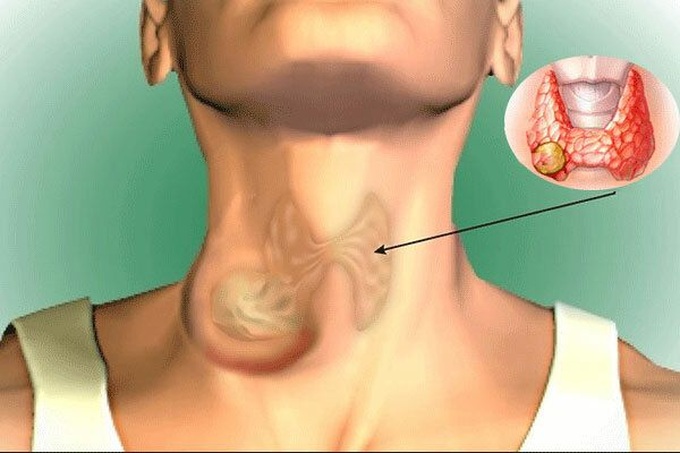 Ung thư tuyến giáp chiếm 90% bệnh nhân ung thư nội tiết, dấu hiệu âm thầm nhưng có thể điều trị được: Bác sĩ BV Bạch Mai chỉ rõ 5 điều quan trọng về căn bệnh này - Ảnh 2. Ung thư tuyến giáp chiếm 90% bệnh nhân ung thư nội tiết, dấu hiệu âm thầm nhưng có thể điều trị được: Bác sĩ BV Bạch Mai chỉ rõ 5 điều quan trọng về căn bệnh này - Ảnh 2.