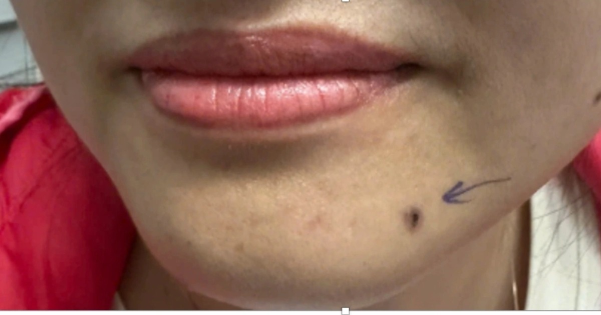 Nốt như hạt đỗ ở cằm hóa ung thư, bác sĩ chỉ dấu hiệu nguy hiểm