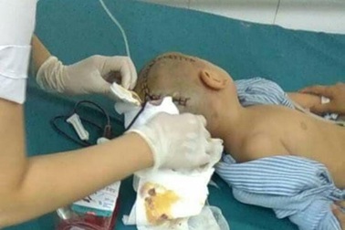 Bé 3 tuổi phải phẫu thuật vì bị chấn thương sọ não ở trường