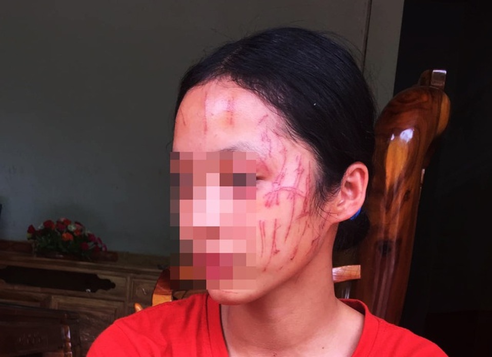 Mới tí tuổi đã cào nát mặt nhau: Các con chúng ta đang làm gì vậy? - 1 Mới tí tuổi đã cào nát mặt nhau: Các con chúng ta đang làm gì vậy? - 1