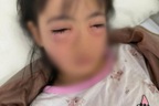 Bé 5 tuổi đi cấp cứu sau khi chơi thổi bong bóng xà phòng