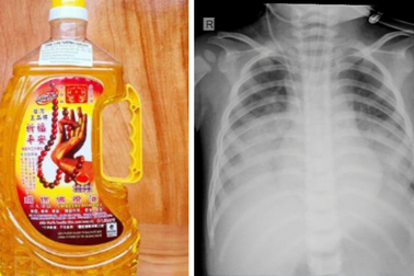 Bé 15 tháng tuổi uống nhầm dầu dùng để thắp đèn