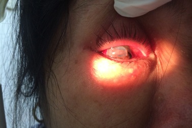 Người phụ nữ bị chồng bạo hành vỡ nhãn cầu mắt đã được ghép giác mạc