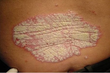 Người bệnh bị ngứa do bệnh vẩy nến 