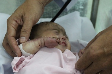 Bé 30 tuần tuổi bị nhiễm trùng, hoại tử được cứu bằng phương pháp mới