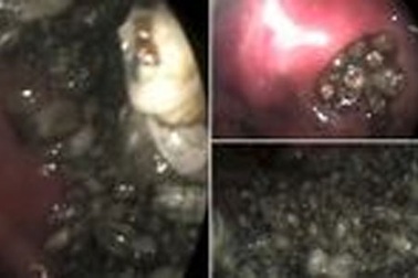 Ghê rợn cảnh giòi “làm tổ” trong mũi