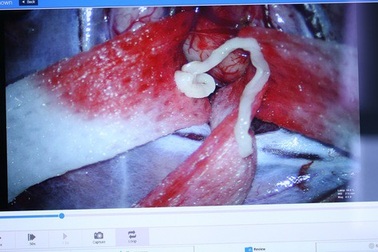 Cận cảnh bắt con sán 7 cm ăn não người đàn ông