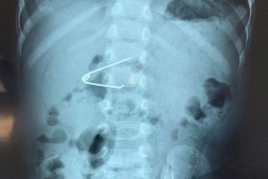 Phẫu thuật lấy cây kim băng găm vào dạ dày bé 18 tháng tuổi