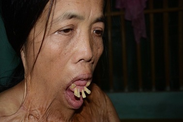 Viện Bỏng Quốc gia chữa miễn phí cho người đàn bà nửa thế kỉ mang hàm răng “kì dị”