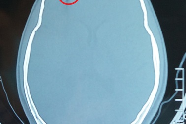 Nam thanh niên bị súng bắn đinh xuyên hộp sọ