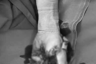 Bé trai 13 tuổi bị cắt cụt tay do vừa sạc pin vừa dùng điện thoại