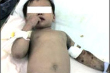 BV Nhi Đồng 1 cấp cứu thành công 2 ca bệnh nặng