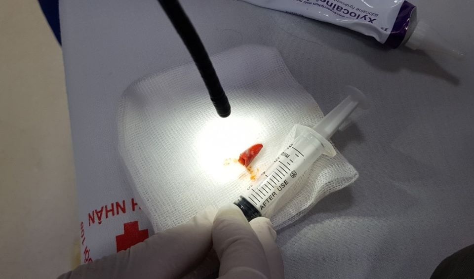 Hy hữu: Mảnh ớt chui tọt vào phế quản bệnh nhân - 1 Hy hữu: Mảnh ớt chui tọt vào phế quản bệnh nhân - 1