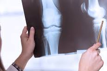 Chữa ung thư xương bằng cách nào?