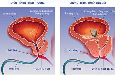 Báo động: Cứ 2 người trong độ tuổi 60-70, có 1 người bị u xơ tiền liệt tuyến
