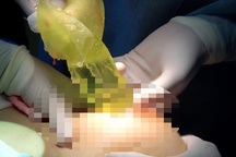 Đặt túi ngực có làm tăng nguy cơ bị ung thư vú?