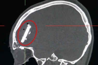 Phẫu thuật khẩn cấp, cứu nạn nhân bị lưỡi cưa ghim trong não