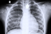 TPHCM: Cấp cứu hai cháu bé gặp tai nạn nguy hiểm khi ăn