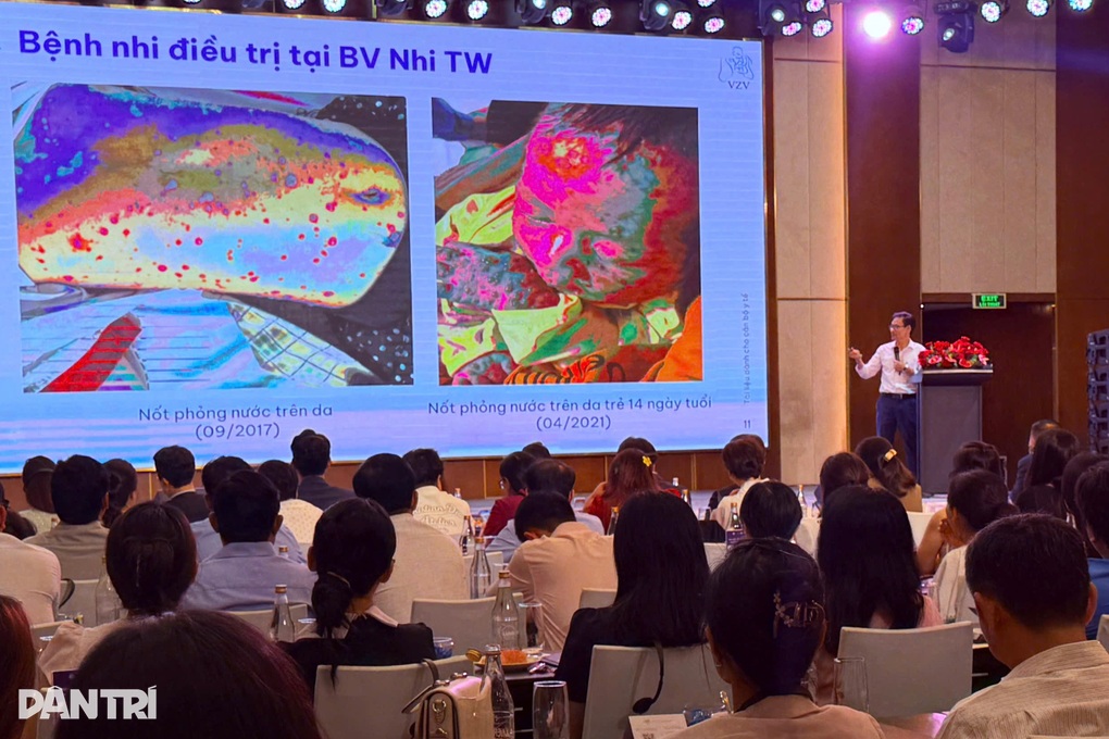 Thủy đậu không lành tính, gây nhiều biến chứng nghiêm trọng - 1