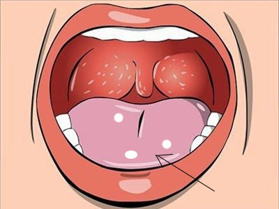 Nhiệt miệng, viêm lợi chữa mãi không khỏi – Nguyên nhân và biện pháp khắc phục hiệu quả - 1 Nhiệt miệng, viêm lợi chữa mãi không khỏi – Nguyên nhân và biện pháp khắc phục hiệu quả - 1