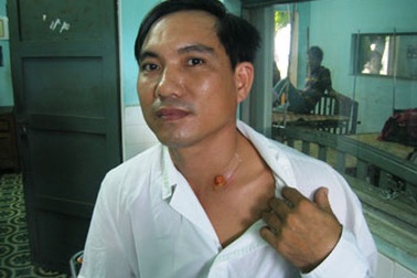 Một vụ hóc xương cá vô cùng hy hữu