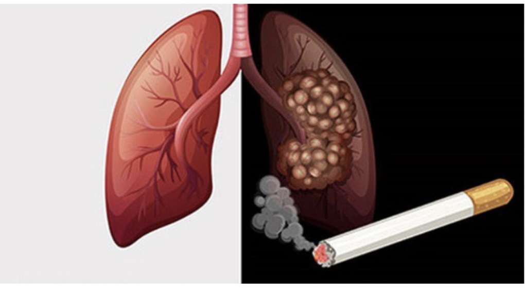 90% người bệnh mắc loại ung thư gây tử vong hàng đầu liên quan đến thuốc lá - 1