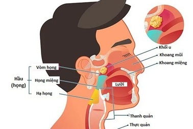 Triệu chứng của ung thư vòm họng là gì?