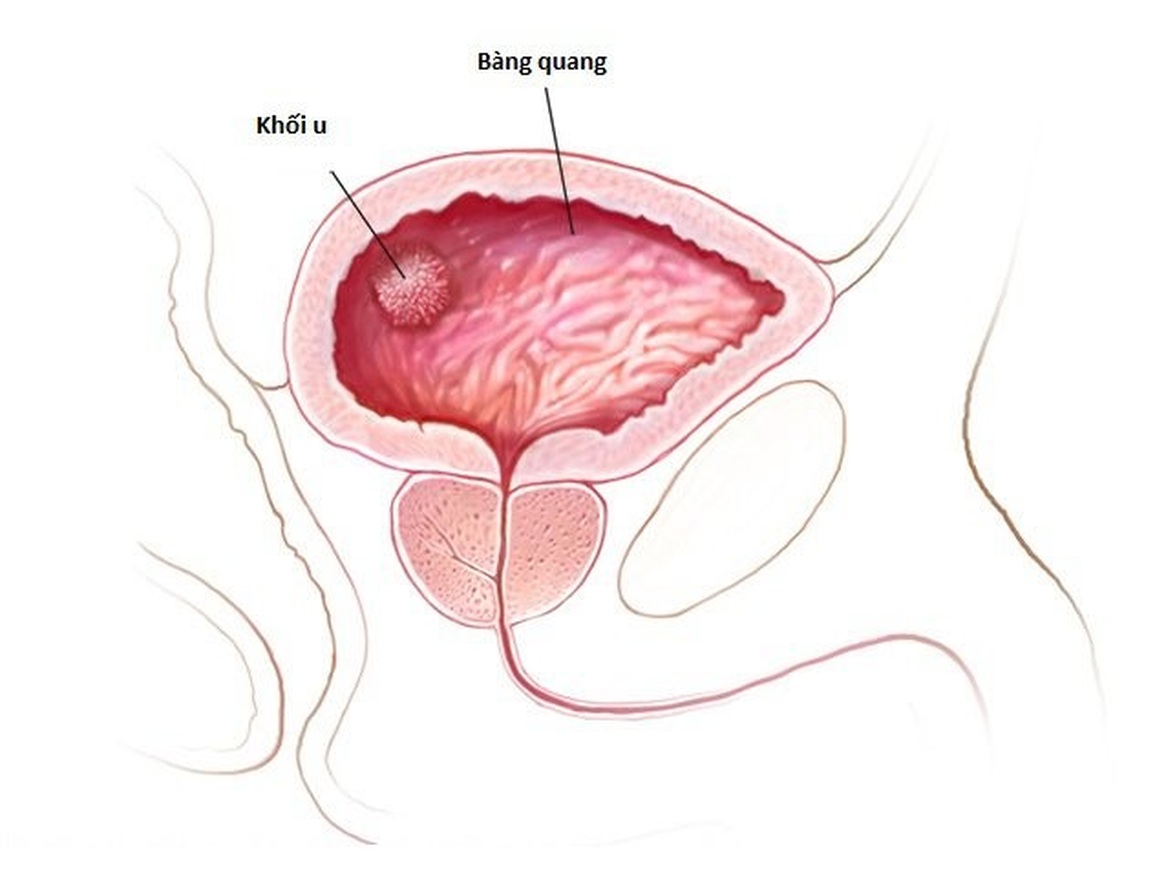 Các triệu chứng của khối u bàng quang lành tính - 1 Các triệu chứng của khối u bàng quang lành tính - 1