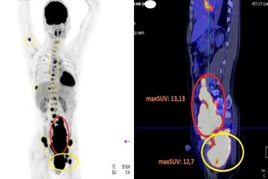 Nam bệnh nhân 35 tuổi ngỡ ngàng phát hiện tế bào ung thư lan khắp người
