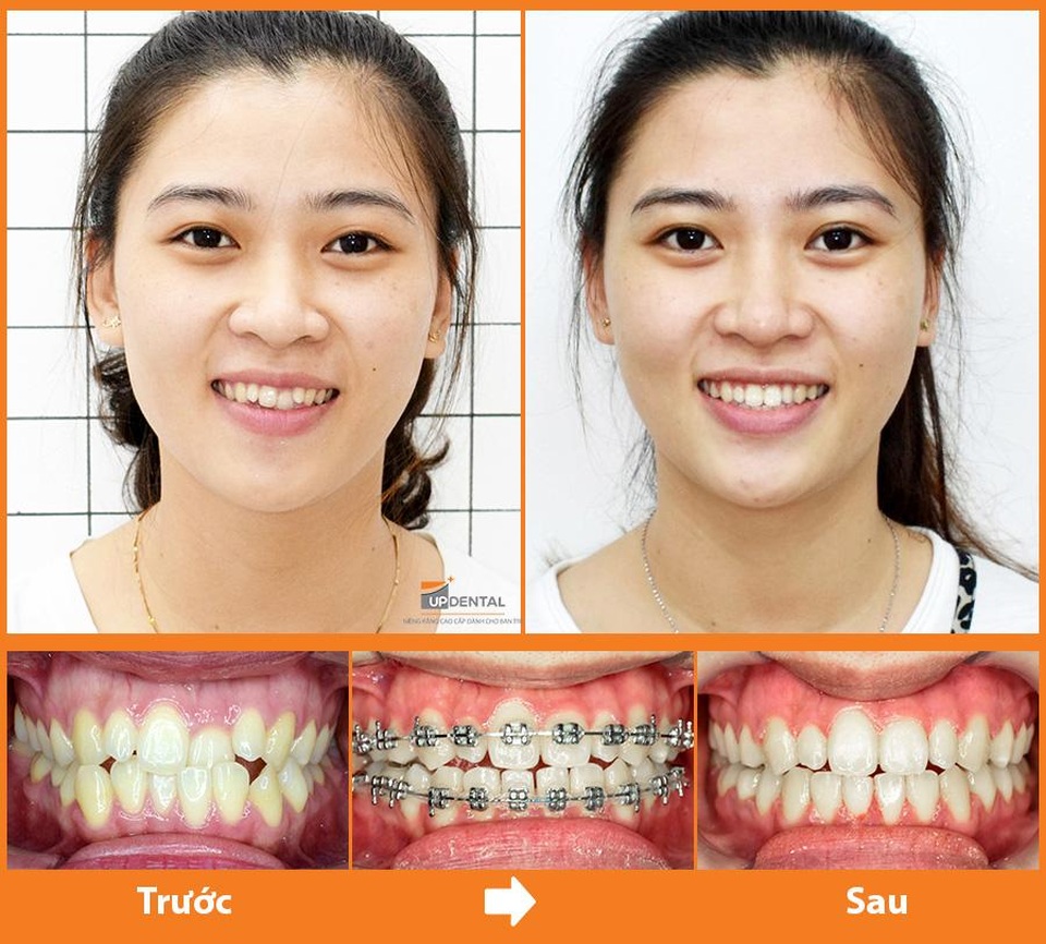 Up Dental: 9x niềng răng giá rẻ 1 triệu/tháng và kết quả bất ngờ - 2 Up Dental: 9x niềng răng giá rẻ 1 triệu/tháng và kết quả bất ngờ - 2
