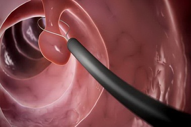 Polyp có dễ thành ung thư?