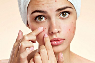 Cách để nặn mụn đúng nhất