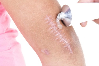 Các biện pháp xóa sẹo tại nhà