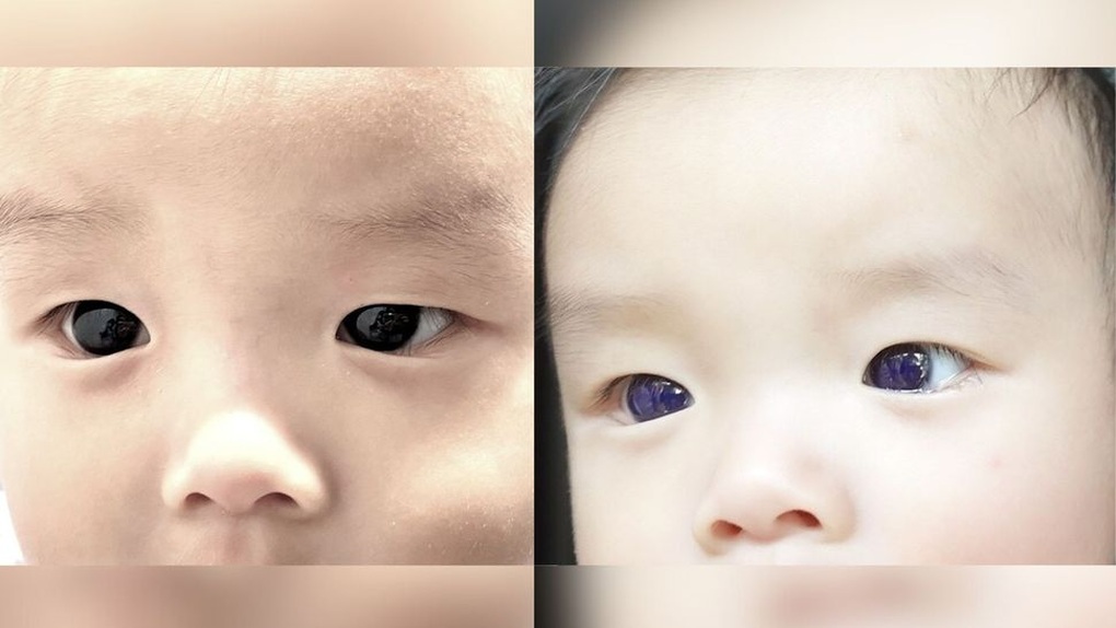 Sau điều trị Covid-19, em bé mắt nâu biến thành mắt xanh - 1 Sau điều trị Covid-19, em bé mắt nâu biến thành mắt xanh - 1