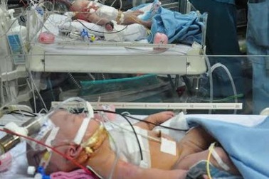 Tạo hình hậu môn cho trẻ trong ca song sinh dính ngực