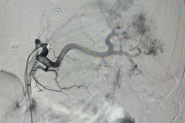 Nút động mạch cứu bệnh nhân vỡ lách máu tràn ổ bụng