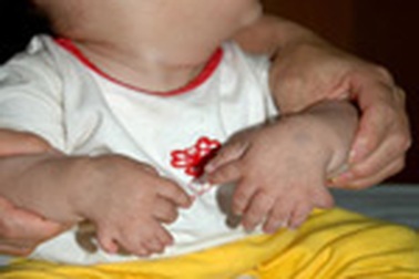 Cậu bé có bàn chân 6 ngón, bàn tay 8 ngón