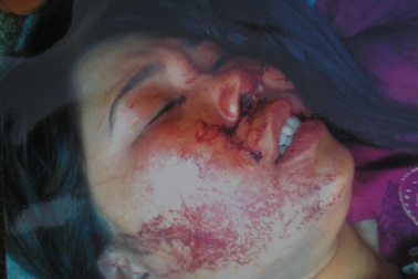 Bắt tạm giam một đối tượng trong vụ vợ chủ tịch xã đánh ghen