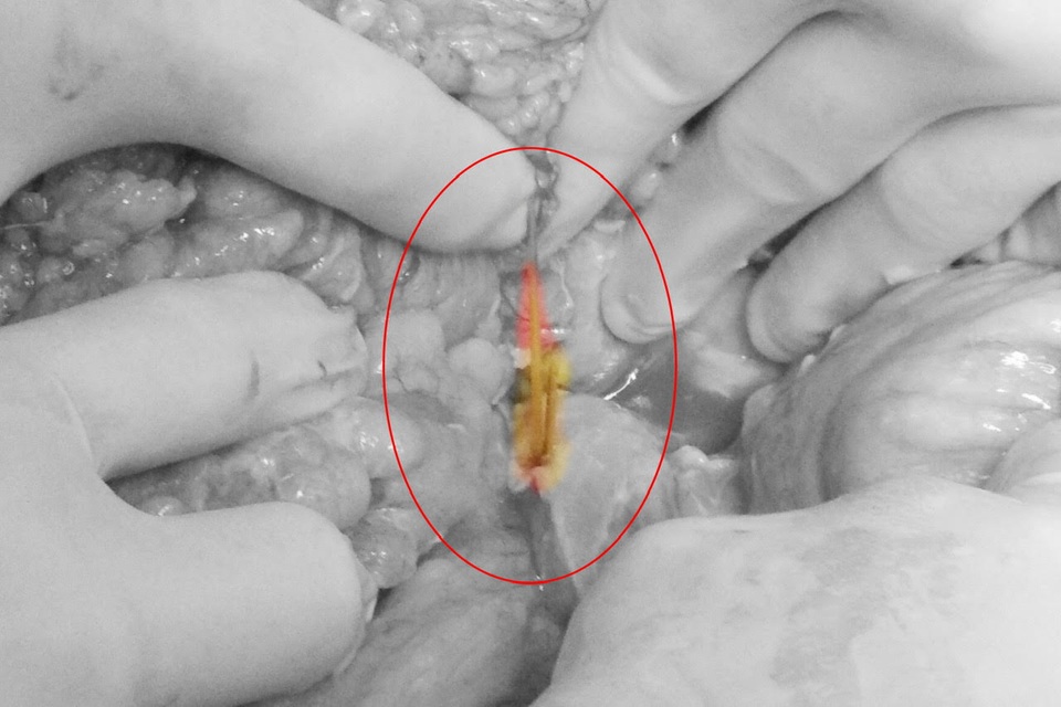 Nuốt 2 cây tăm khi uống bia, người đàn ông gặp tai họa - 1