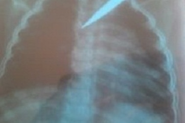 BV Nhi Đồng 1: Cấp cứu kịp thời cứu bé 5 tuổi bị kéo đâm xuyên ngực